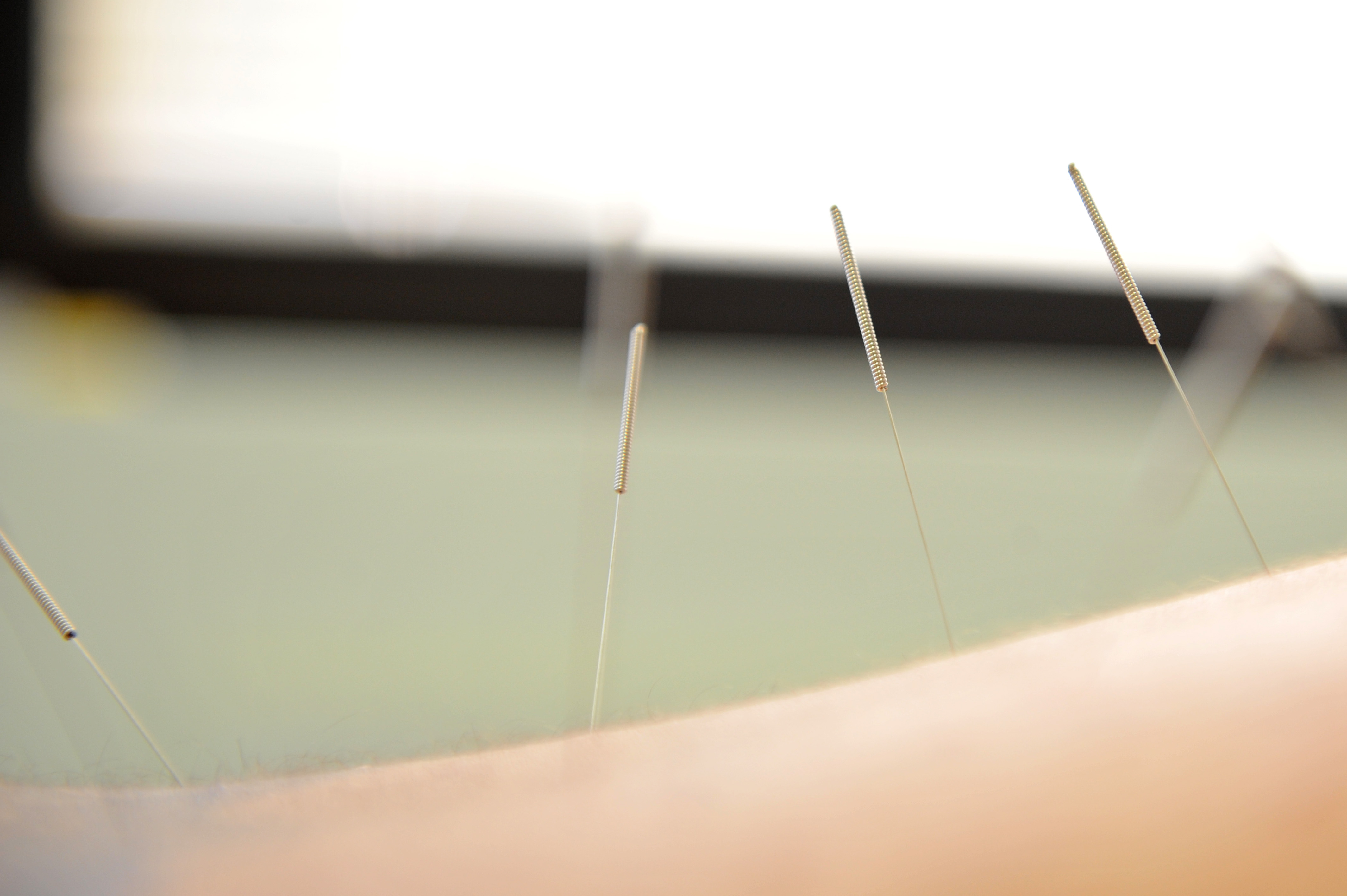 Top 3 Surprises About Acupuncture