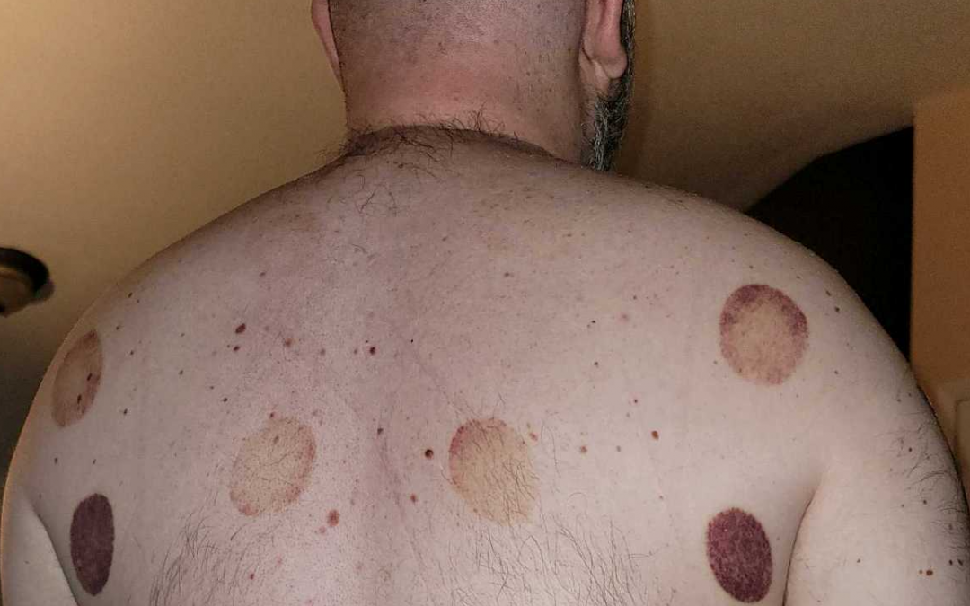 What exactly is cupping?
