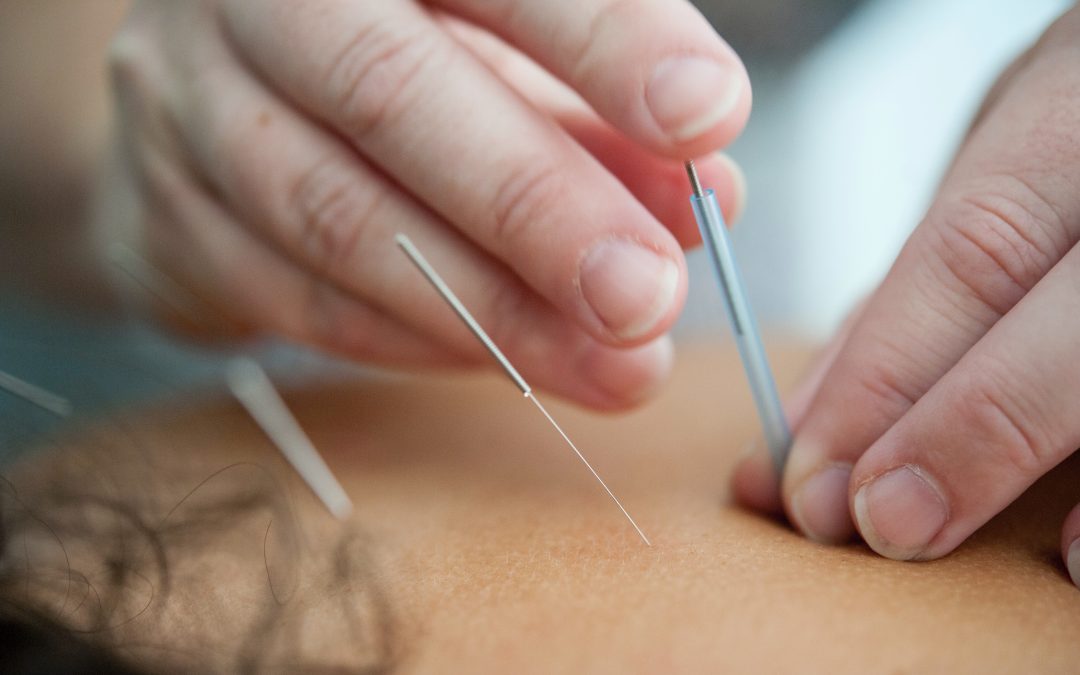 Acupuncture for Allergies